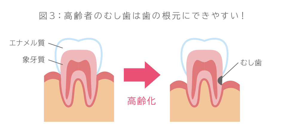 図3：高齢者のむし歯は歯の根元にできやすい！