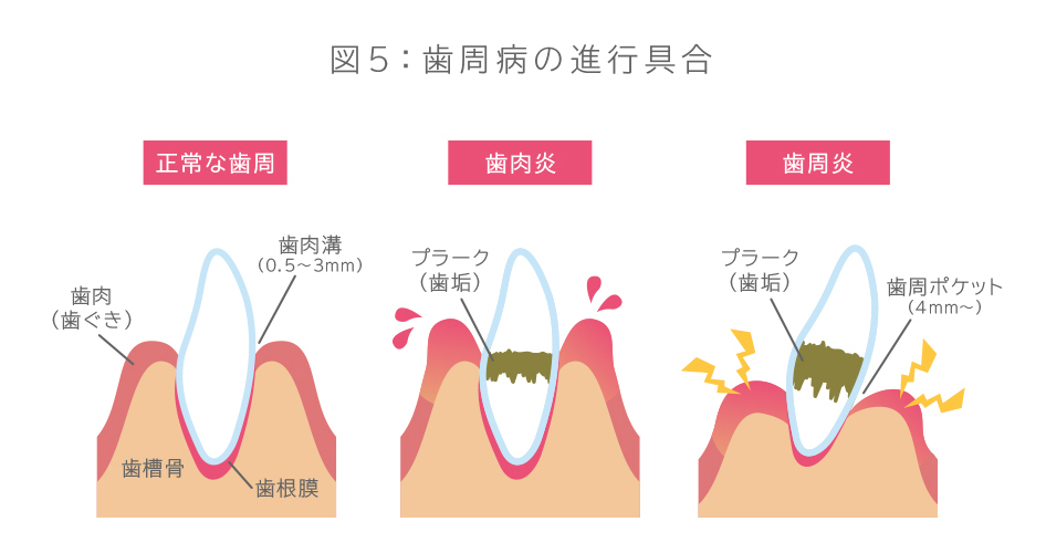 図5：歯周病の進行具合